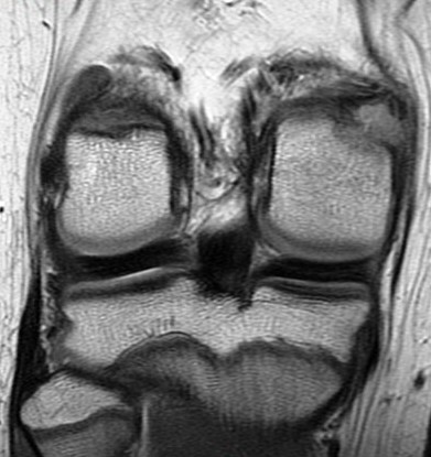 Figure 3 for case avulsion fracture MFC and tibial tubercle fx ( RID2896 ) ( RID4653 )